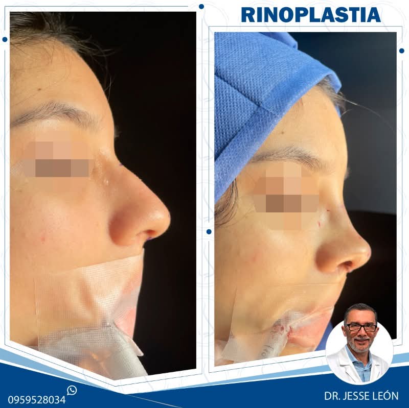 Rinoplastia antes y después